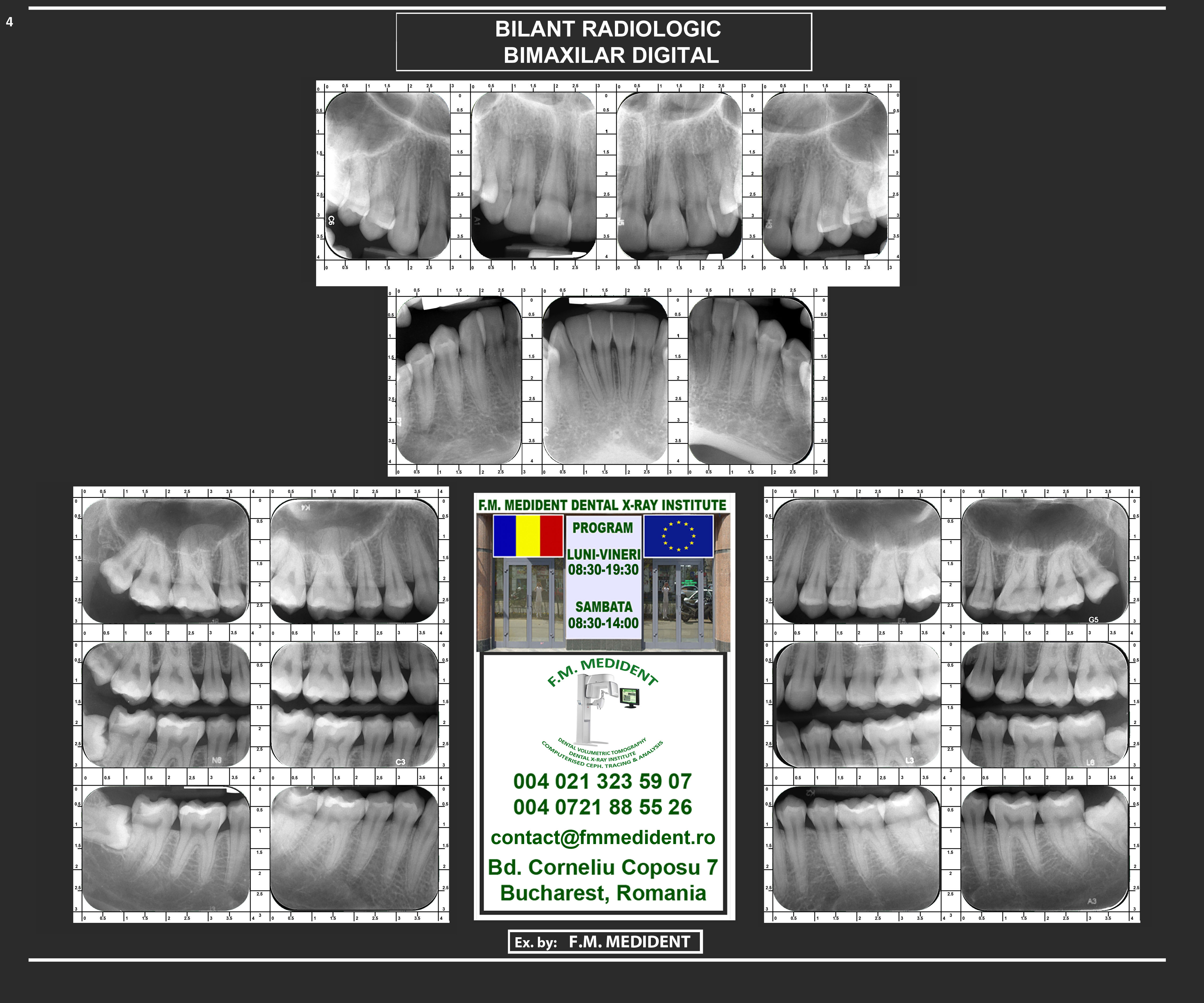 Full mouth radiographic survey-Paralleling technique(FMX)